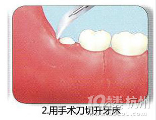 智齿是怎么拔的? 看完后简直吓尿了!-口水-口水