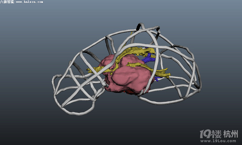 3D打印建模,完美辅助肿瘤手术。-网友自留地-