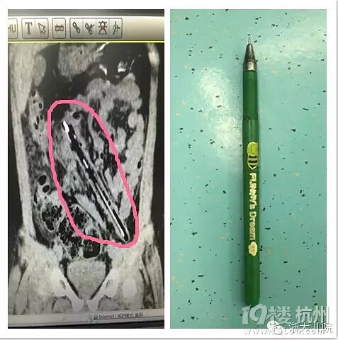 熊孩子居然把一支15厘米的筆塞進了…… 