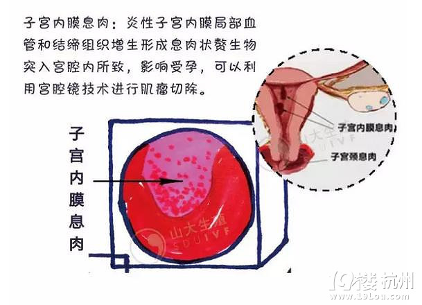 子宫的镜子--宫腔镜检查-健康提醒-女性健康-杭