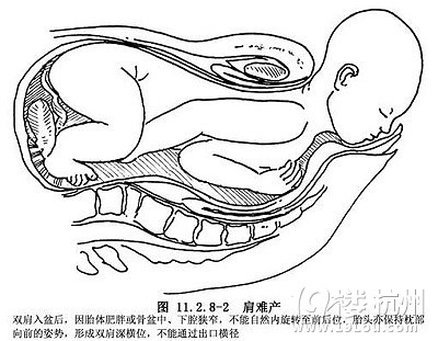 肩難產(chǎn)是什么？如何預(yù)防早知道！