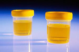 尿常规参考值是多少?宝妈们一起来学习吧~-宝