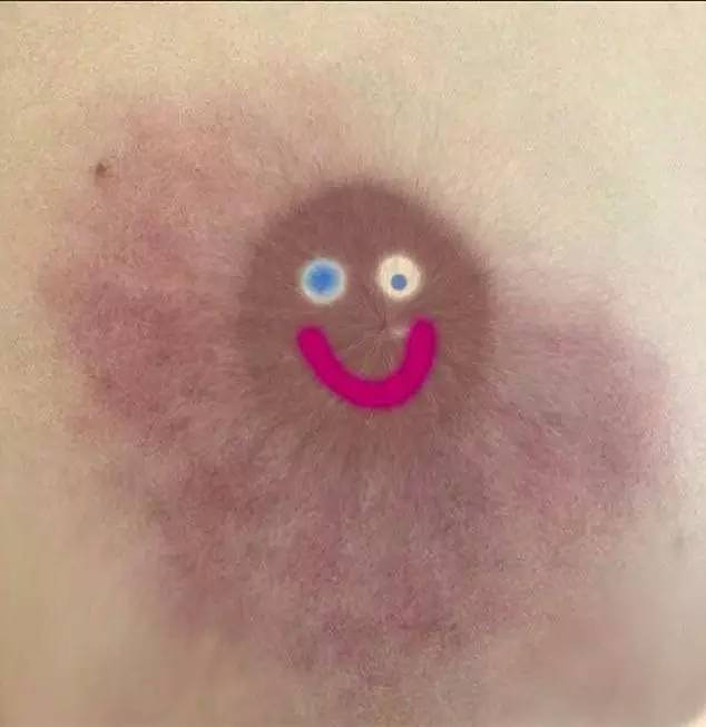 近日,英国女子金凯德在社交媒体上传了一张自己乳房的照片.
