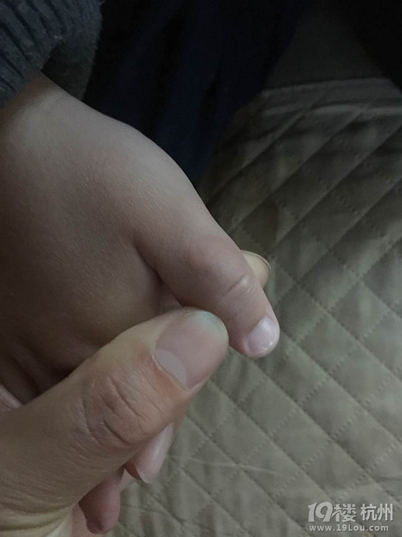 求助！寶貝長時間吃手指，吃出了這種東西...