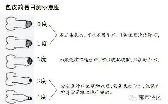 男子花上万元去割包皮 老婆嫌弃它难看险些