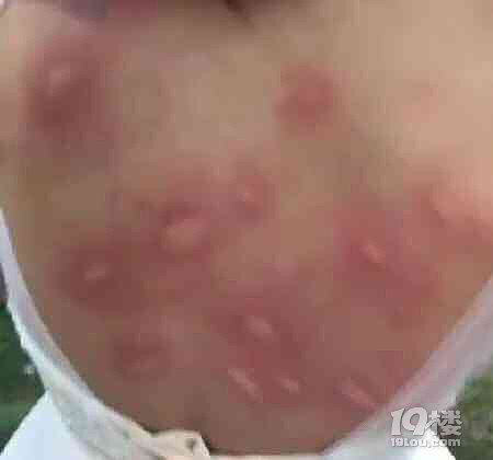 伴娘穿的太少 婚禮現(xiàn)場(chǎng)被咬的滿身膿包