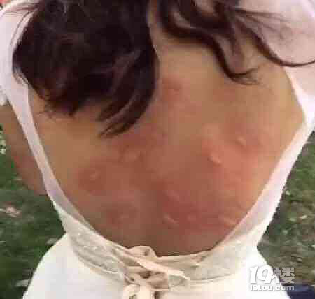 伴娘穿的太少 婚禮現(xiàn)場(chǎng)被咬的滿身膿包