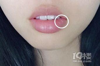 嘴唇唾液腺囊肿 一定要手术吗?