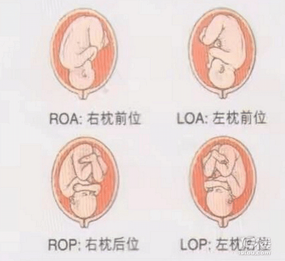 胎位loa是什么意思