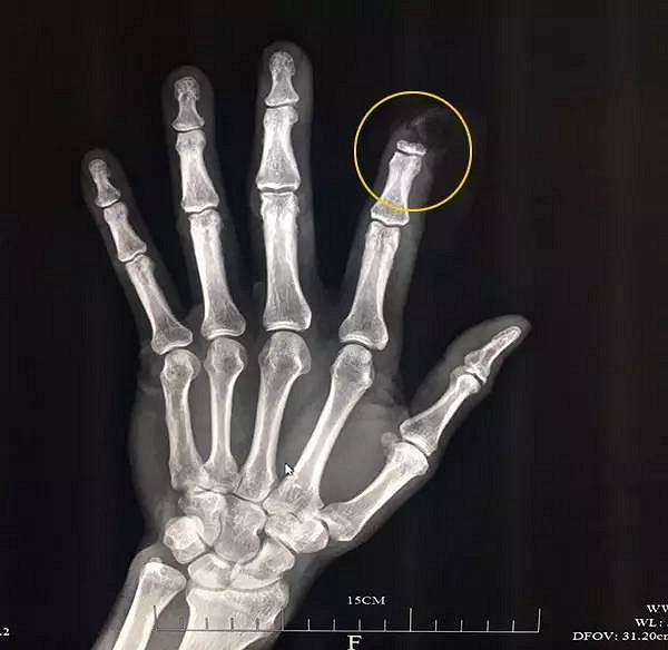 这里骨头都露出来了,你看(她伸出左手食指,右手示意截去一小节.