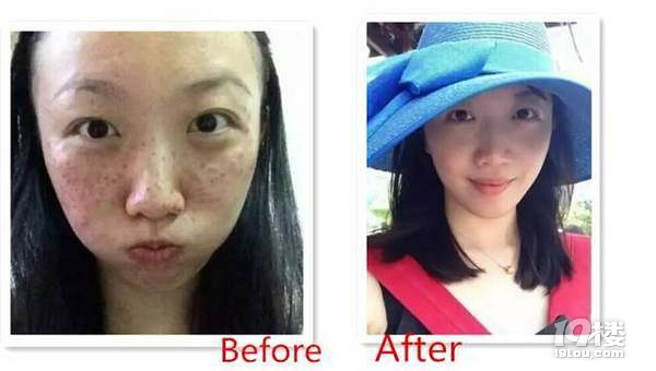 想去做个激光祛斑,杭州哪家医院比较好,求