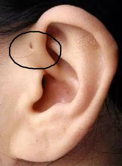 老底子把耳前瘘管叫做"仓眼,认为耳朵旁边有个小孔,是福气好的象征