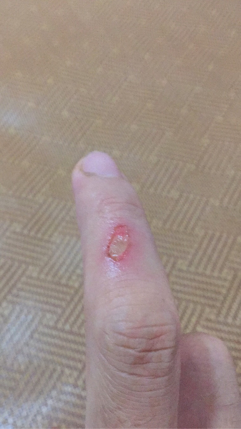 为什么受伤的总是我