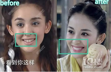 Baby小虎牙消失,原来整牙可以这么美!