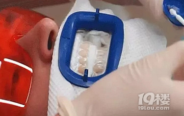 Baby小虎牙消失,原来整牙可以这么美!