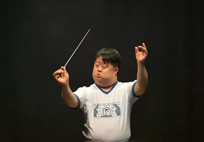 他是唐氏综合征患者,先天性愚型儿.