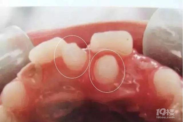 孩子有多生的牙齿，需要拔掉吗？_图2