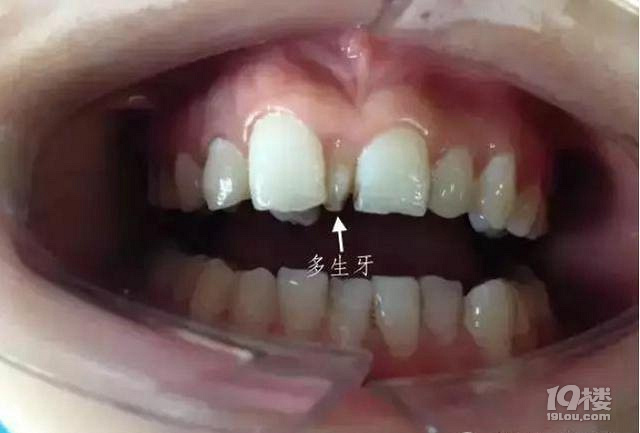 孩子有多生的牙齿，需要拔掉吗？_图1