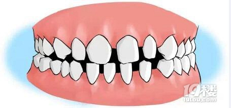 牙齿稀疏怎么办?可以带牙套吗?