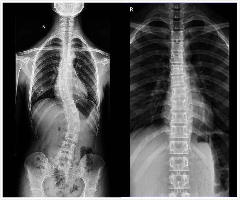 高低肩,驼背,歪脖子…小心脊柱侧弯!4个方法为孩子检查
