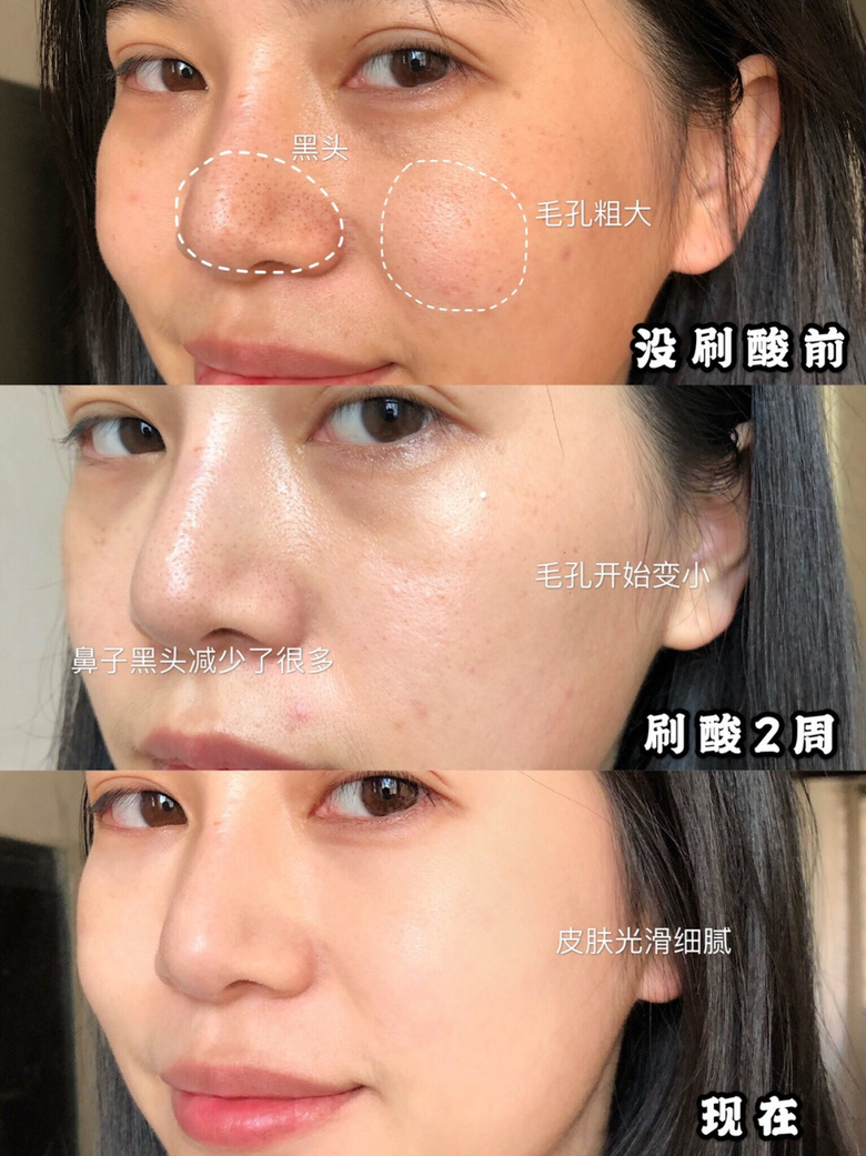 最流行的換臉大法「刷酸」，試了一次我就后悔了！？