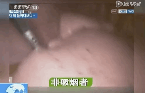 杭州19楼 杭州消息 早知道 社会 帖子  肺部内窥镜记录下的影像片段.