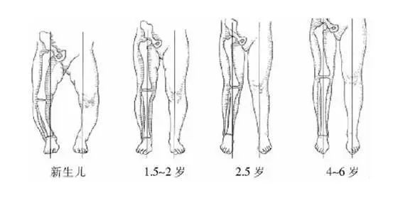 杭州19楼 健康公社 健康之家 帖子 婴儿期:「o 型腿」明显(胫骨股骨向