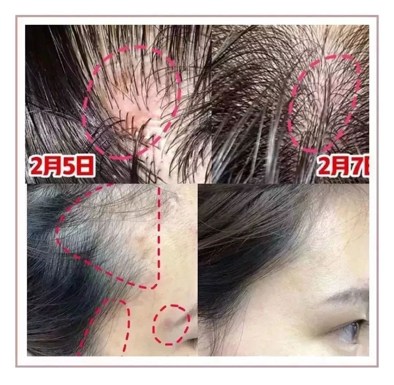 家里蹲的第10天，我的頭發(fā)里竟然長了這種東西！