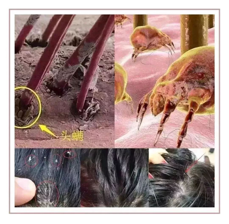 家里蹲的第10天，我的頭發(fā)里竟然長了這種東西！