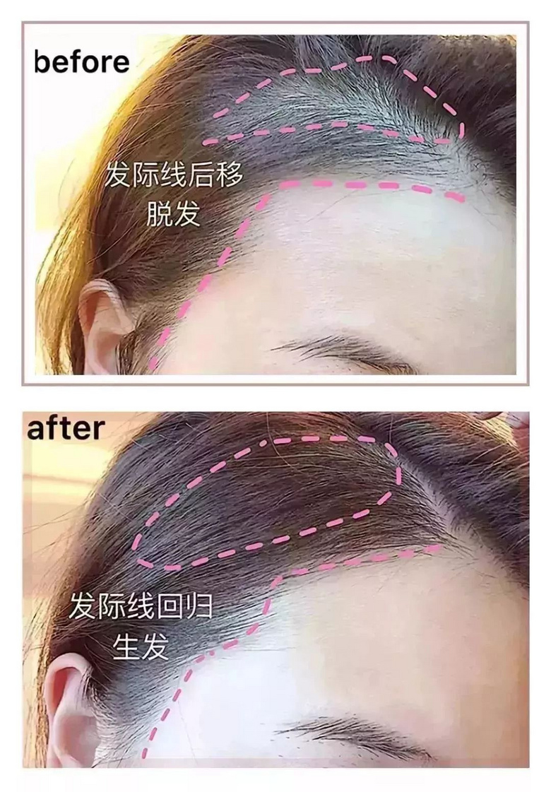 家里蹲的第10天，我的頭發(fā)里竟然長了這種東西！