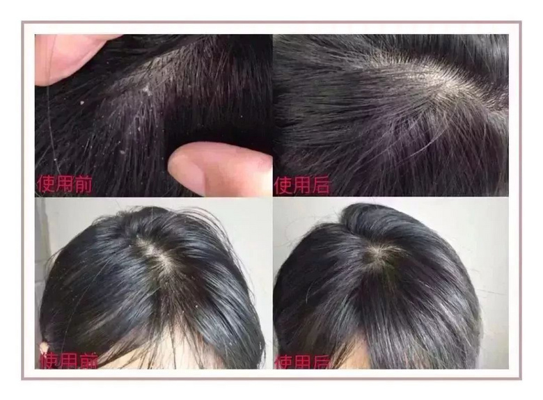家里蹲的第10天，我的頭發(fā)里竟然長了這種東西！