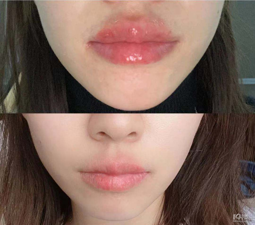 唇炎患者伤不起健康资讯唇炎 健康之家 杭州19楼手机版