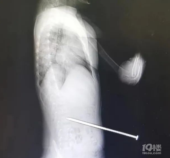 6歲男孩瞬間被長釘插入腰部，多處“頂流”地標明確：禁止！