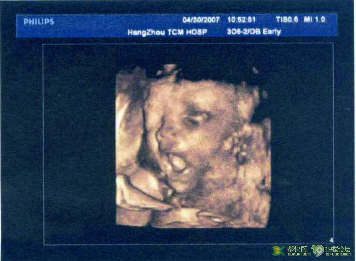 开心妈妈26周市中医院三围B超