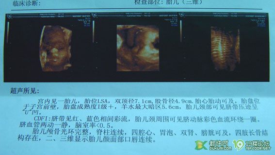 早上刚去市二做的三维B超图,鼻子好大哈-准妈