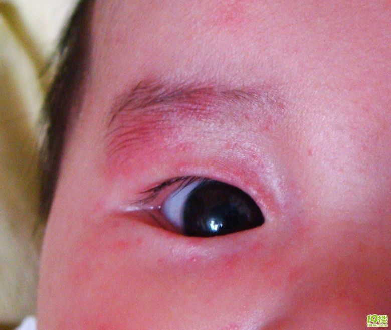 急,请教:宝宝为什么眼睛周围红的发痒?-孩爸孩