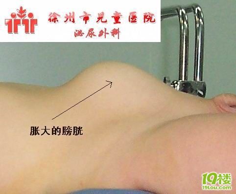 三鹿毒大全受害者和表情奶粉结石吃图片铁图片包图片