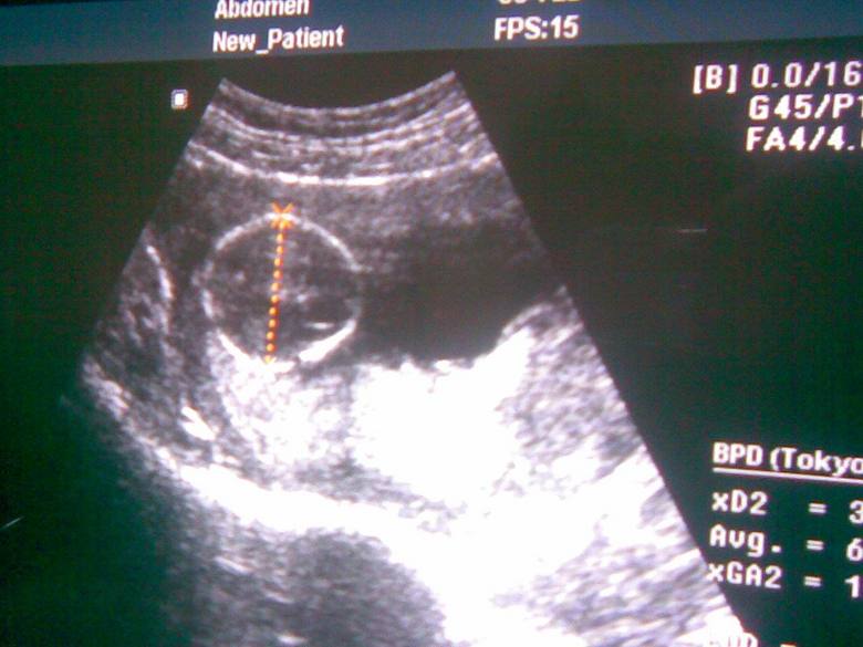 15周BB<em>图片</em>请<em>姐妹</em>们帮我看男女-准妈妈论坛-