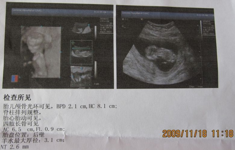 孕13周 B超图,谁能帮我分析一下是男是女?-准