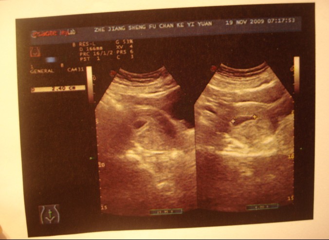50天的B超单,据说看早期胚囊可以看男女,大家