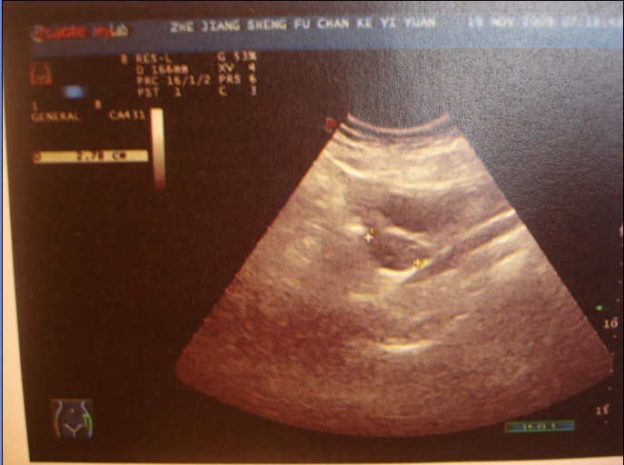 50天的B超单,据说看早期胚囊可以看男女,大家