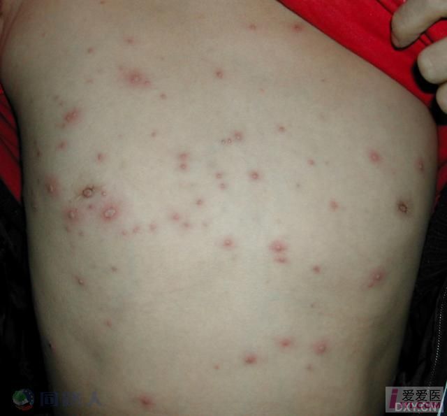 麻疹与水痘的区别