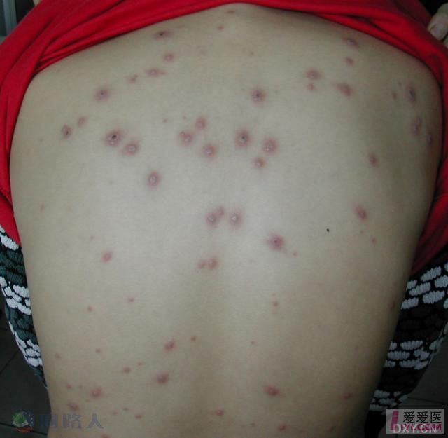 麻疹与水痘的区别-养生保健-杭州19楼