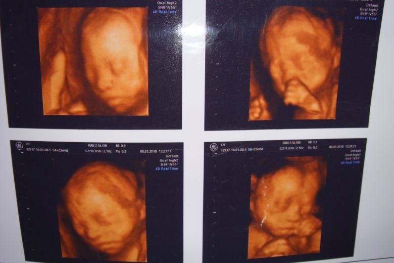 24周 清晰四维照片,猜男女喽(附图片)-准妈妈论坛-杭州19楼