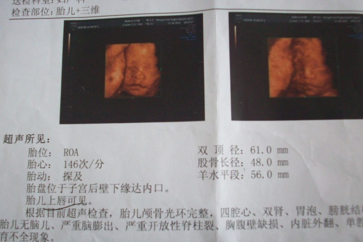 孕31周+6天,三维B超图,大家猜猜男宝还是女宝
