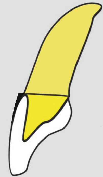 钯银合金烤瓷牙和金合金烤瓷牙的区别-养生保