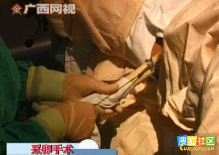 实图记录人工授精全过程 罕见-健康之家-杭州19楼