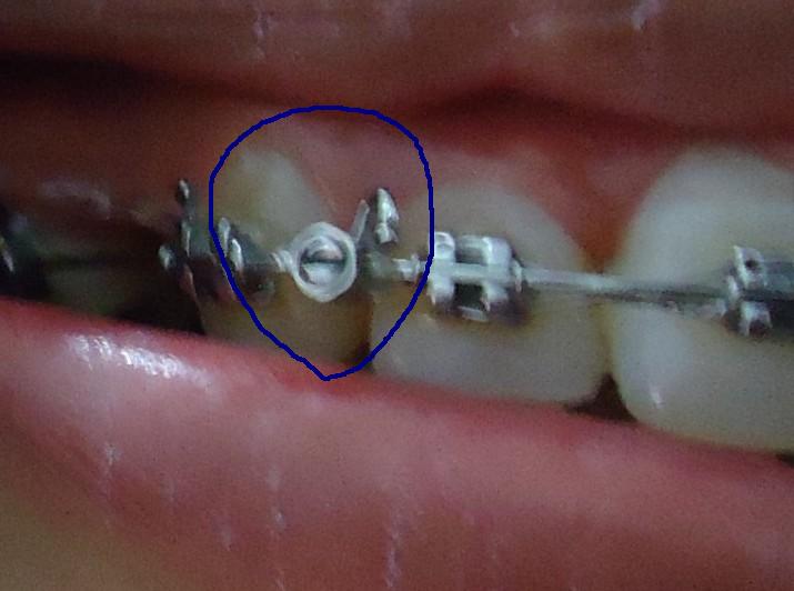 整牙日记(2010.6.5开始)-第5页-网友经验-养生保