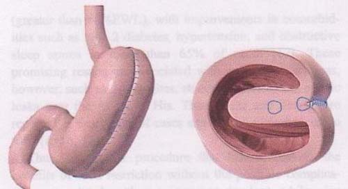 胃缝小减肥术 东北<em>女士</em>首次在杭尝试(图)-健康