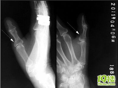 老太被撞摔伤拍X光片 家属索辐射损伤费(图)-转